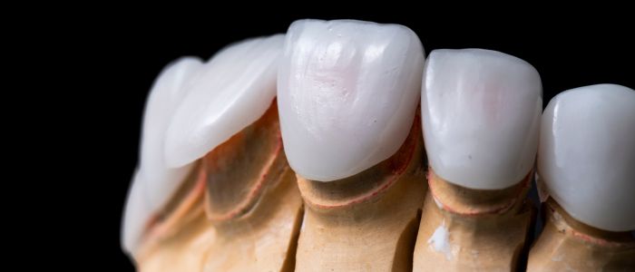 фасети за зъби