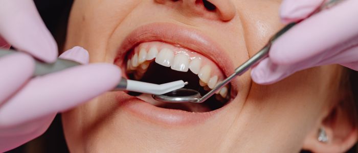 Какво представляват фасетите за зъби и кога са подходящи