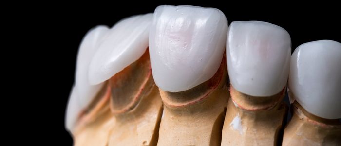 фасети за зъби