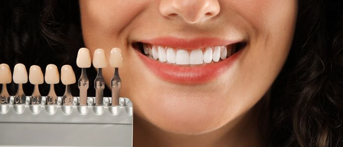 Кога фасетите за зъби са подходящи