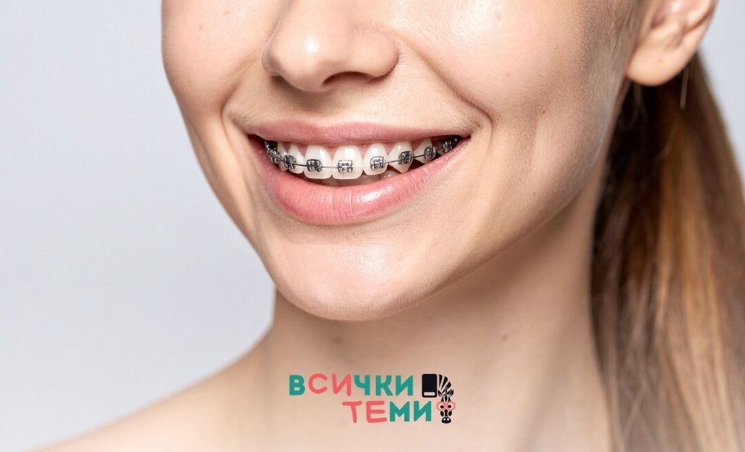 Брекети за възрастни: какво да знаеш преди започване
